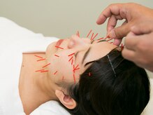 もり鍼灸整骨院 今出川マッサージ治療院/美容鍼/小顔矯正
