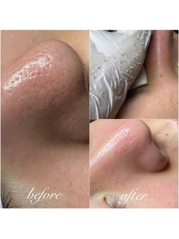 セリジェ 青山(Cerisier)/マスター新技術の毛穴ケア♪