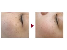 マロン(MARON)/ホワイトピーリング