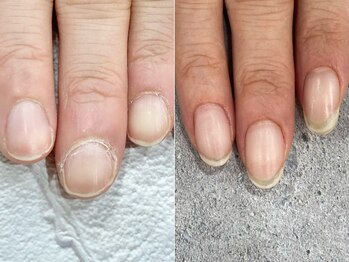 リファーレ(RIFARE)/【深爪矯正】丸い爪から縦長爪へ