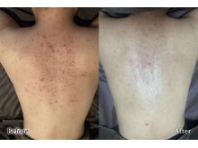 アネル 美里店(anel)/背中のニキビもお任せ♪