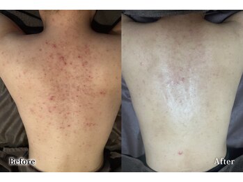 アネル 美里店(anel)/背中のニキビもお任せ♪