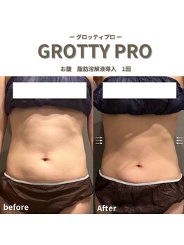 フルアナ(Hu ruana)/痩身/ダイエット/筋膜リリース