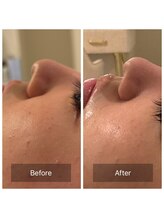 アスボーテ 月島(As Beaute’)/ニキビの鎮静にも◎