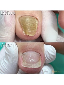 巻き爪補正店 越谷店/変形爪補正