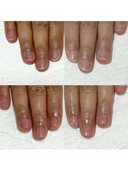 セラキュアネイル(Theracure nail)/爪の印象はケアで変わります