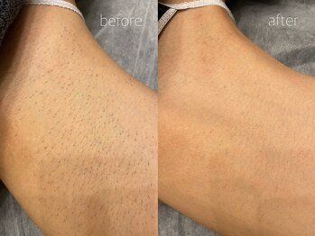 オンセ(once)/VIO脱毛/足脱毛/全身脱毛