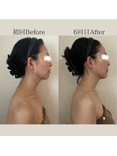 リーブル(LIBRE)/小顔コルギ　6回