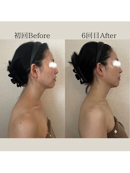 リーブル(LIBRE)/小顔コルギ 6回