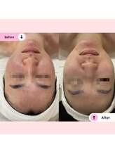 アネラ(ANELA)/ニキビケア　赤み