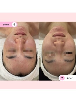 アネラ(ANELA)/ニキビケア　赤み