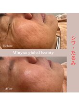 ミニョ コリアンビューティー(Minyoo korean beauty)/症例写真/シワ・たるみ
