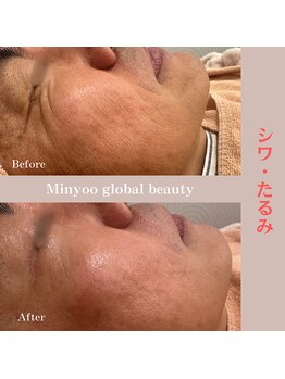 ミニョ コリアンビューティー(Minyoo korean beauty)/症例写真/シワ・たるみ