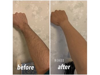 セルフメイド 宇都宮店(SELFMADE)/腕Before→After