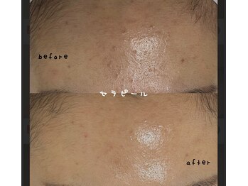 ルシアス/セラピール before after