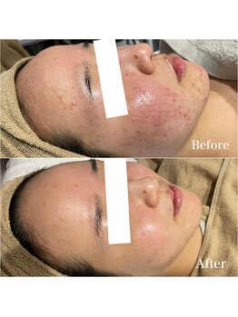 リブ(Lib)/諦めていたお肌もリプロで一撃