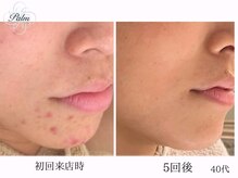 パーム(Palm)/肌質が変わりトラブルのない肌へ