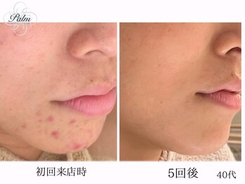 パーム(Palm)/肌質が変わりトラブルのない肌へ