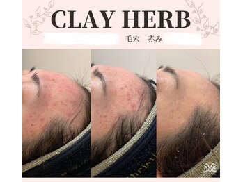 スリジエ ボーテ(cerisierBEAUTE)/繰り返すニキビケア！！