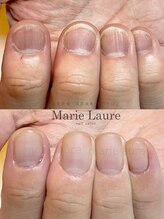マリーロール 淀屋橋本店(Marie Laure)/自爪育成/深爪矯正/ネイルケア