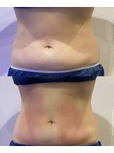 フィックスユー ビューティー(Fixyou BEAUTY)/脂肪冷却 before after