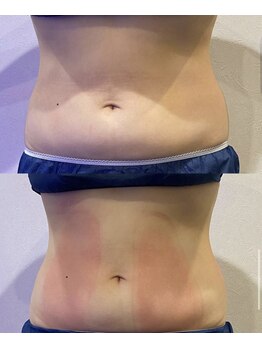 フィックスユー ビューティー(Fixyou BEAUTY)/脂肪冷却 before after