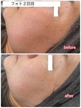 サロンドティアラ(Salon de Tiara)/フォトフラクショナル