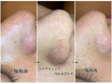 アルティ 福岡大名店(ARTI,)/毛穴洗浄