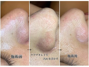 アルティ 福岡大名店(ARTI,)/毛穴洗浄