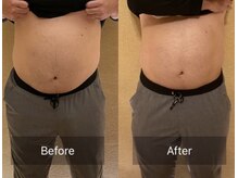 ルキア(LUKIA)/痩身【脂肪冷却】症例７　おなか