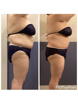 リッシュ(RICHE)/キャビゼロ＆レモンボトル