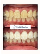 NAホワイトニング 船橋店/ホワイトニングビフォーアフター