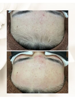 ノノ(nono)/顔脱毛、おでこも明るい印象に♪