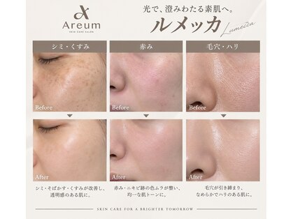【たるみケア・シミケア・毛穴】エイジングケアAreum(アルム)戸塚の写真