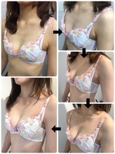 ラポッシュ(La poche)/バストアップ症例写真