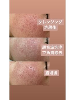 ミント(mint)/#毛穴洗浄#ハーブピーリング