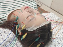 明円鍼灸治療院の雰囲気（もう普通の美容鍼には戻れない。ヒト幹細胞電気美容鍼◆）
