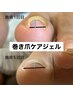 巻き爪改善☆痛み軽減《巻き爪ケアジェル(２本)＋ベーシックフットケア》