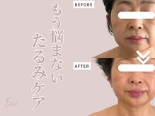 エニ(Eni)/若見え実感リフトアップエステ