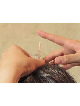 鍼灸施術を受けたい