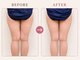 ヨサパーク ビリュウ(YOSA PARK Bellyu)の写真/パンパンな下半身やセルライトにお悩みの方へ！温めケア×本格リンパで憧れの美脚＆美尻へ☆