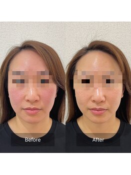 ラ クレール ビューティーサロン(LA CLAIR)/小顔リフトマシン豊富に取り揃え