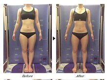 ビューティークリニックコダマ 日向店/【2か月コース】M.H様（21歳）