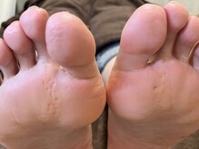 フットタイムズ(FOOT TIMES)の雰囲気（小さな魚の目も痛くなる前に早めのケアを！）