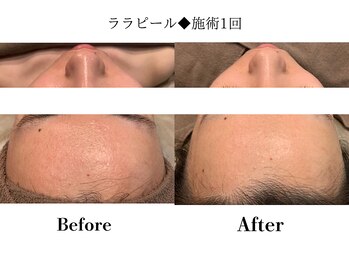 フレイヤ(FREYA)/ララピールBefore→After