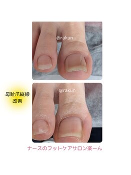 楽ーん/トラブル爪施術事例♪