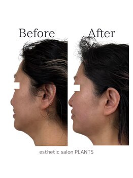 プランツ(PLANTS)/施術１回／たるみ・小顔・二重顎