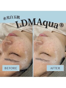 ウリ(uli beauty)/LDM超音波マシン