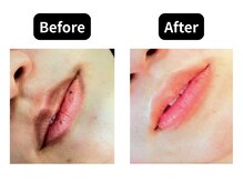 モンロー(MonroE+)/黒ずみ・くすみ・色素ケア