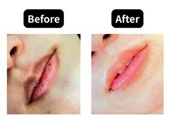 モンロー(MonroE+)/黒ずみ・くすみ・色素ケア